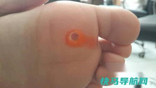 鸡眼怎么根治不复发
