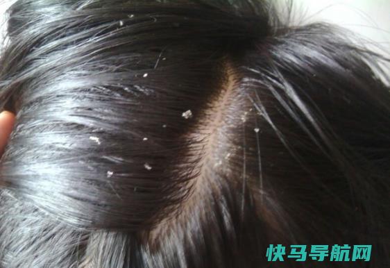 去除头皮屑？为什么会有头皮屑？